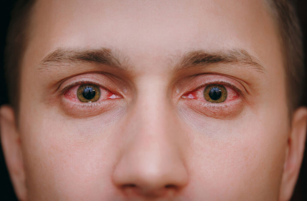A close-up of a person with bloodshot eyes.